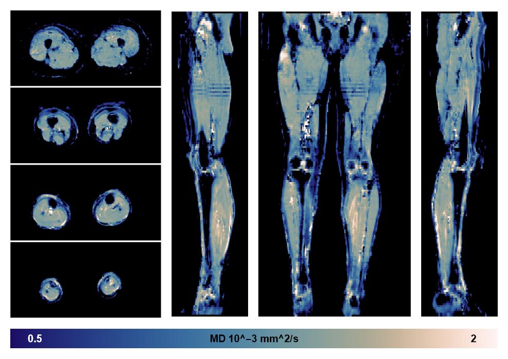 IVIM corrected whole leg muscle mean diffusivity obtained from diffusion tensor imaging.